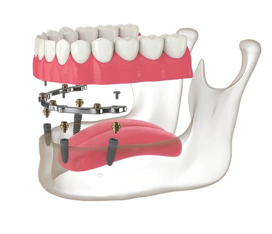 Bar-retained overdenture lifting off the metal bar that connects four implants