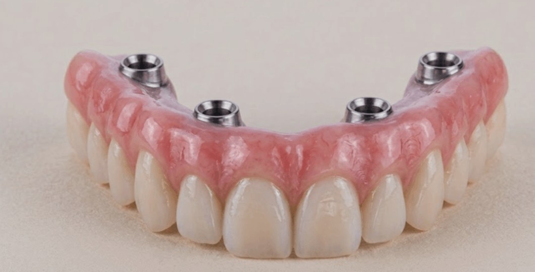 Fixed hybrid full-arch denture showing the implant attachment points