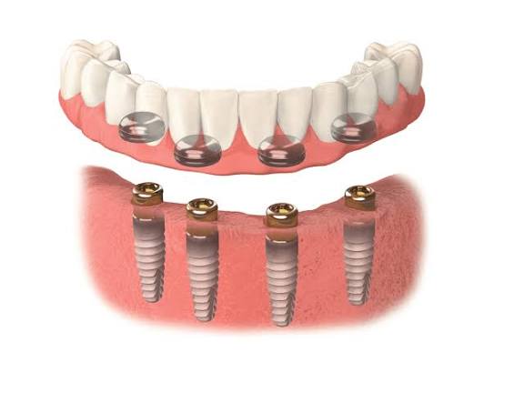 Locator overdenture snapping onto four implants in the lower jaw